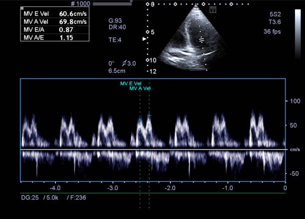 Echocardiogram Doppler measurement on an ultrasound display
